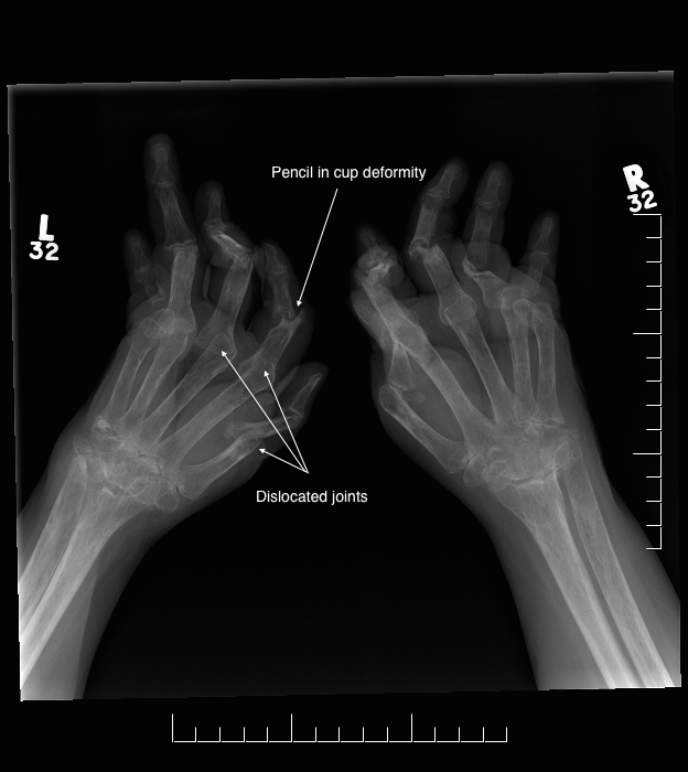 X-ray of both hands showing arthritis mutilans, a late-stage finding of rheumatoid arthritis