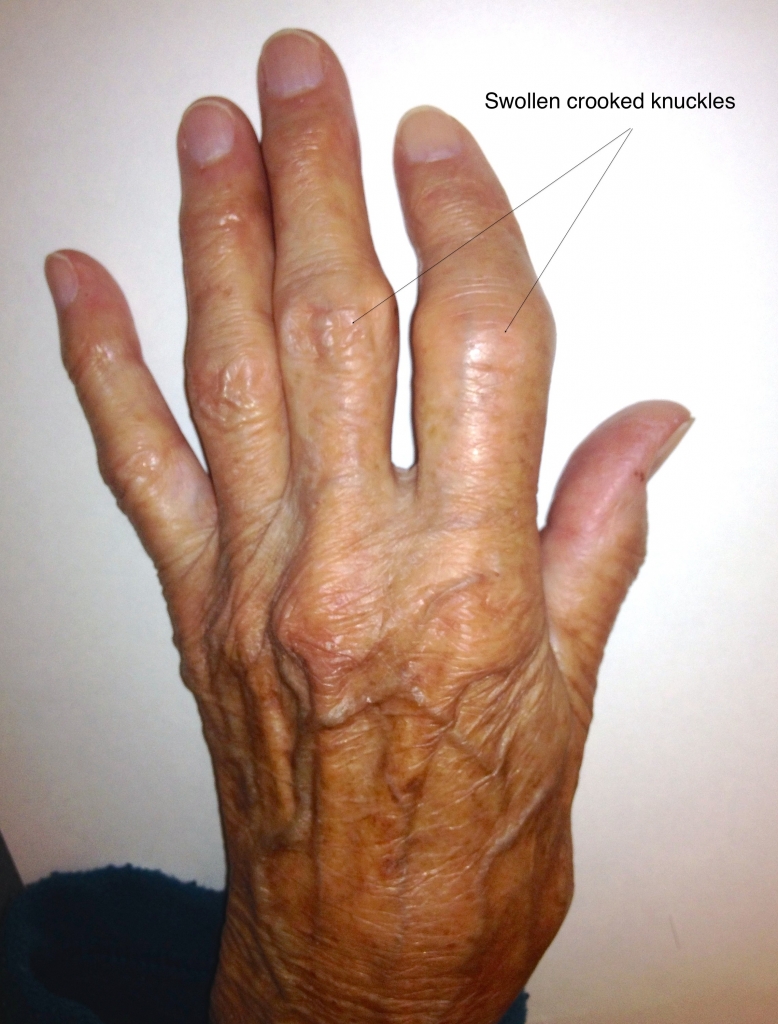 Photograph of a hand affected by arthritis, showing swollen, crooked knuckles
