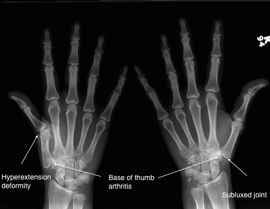 X-ray showing base of thumb arthritis, with a hyperextension deformity and a subluxed joint