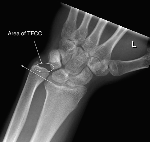 X-ray showing the area of the TFCC