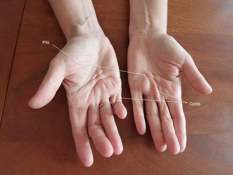Photograph of hands showing thickened cords and finger contracture from Dupuytren's disease