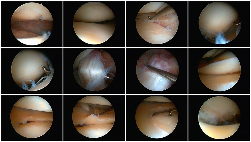 Arthroscopic view from inside the knee