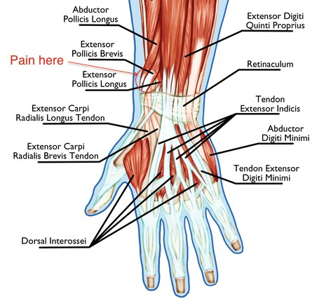 Illustration of the back of the hand and wrist showing the tendon crossing point involved in intersection syndrome