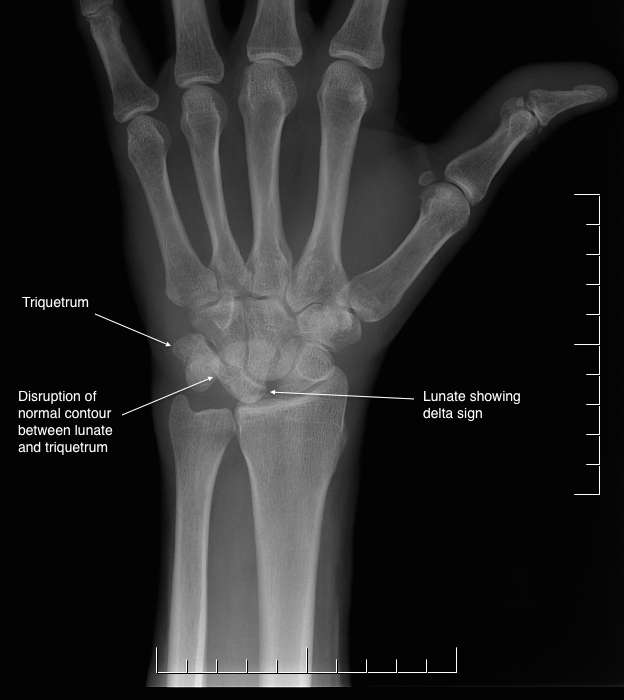 X-ray showing a lunotriquetral tear, with the lunate showing the delta sign