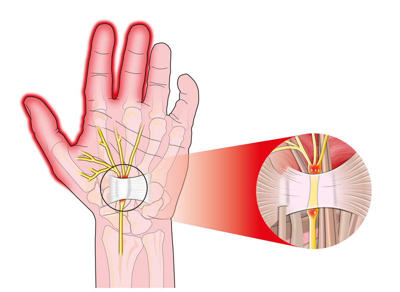 Illustration of the median nerve at the wrist showing the site of compression in carpal tunnel syndrome