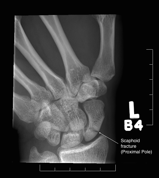 X-ray showing a scaphoid fracture at the proximal pole