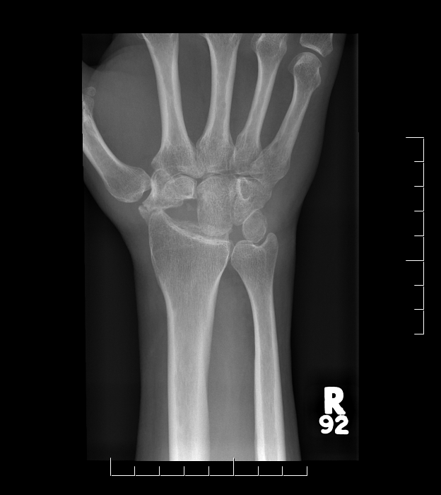 X-ray following a proximal row carpectomy, showing the scaphoid, lunate, and triquetrum removed
