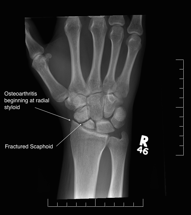 X-ray showing a SNAC wrist, with a fractured scaphoid, osteoarthritis beginning at the radial styloid, and the lunate pointing dorsally