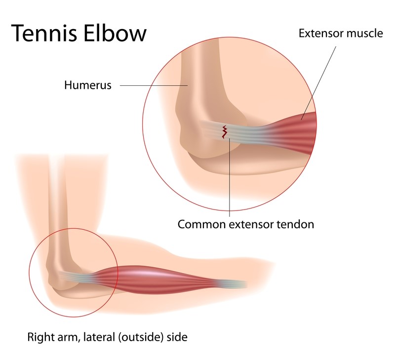 Illustration of tennis elbow showing degeneration of the common extensor tendon at the humerus