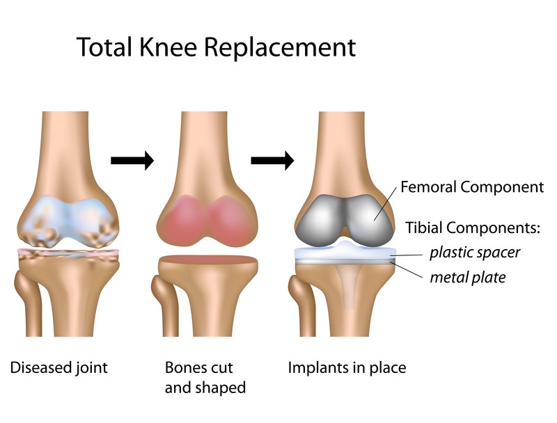 Total knee replacement, showing the diseased joint, bones cut and shaped, and implants in place