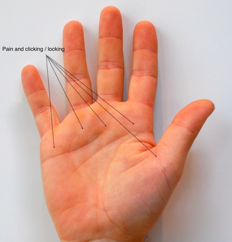 Illustration showing the A1 pulley and flexor tendon anatomy involved in trigger finger