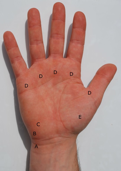 Photograph of the palm side of the hand and wrist, with points A to E marking common sites of volar wrist pain